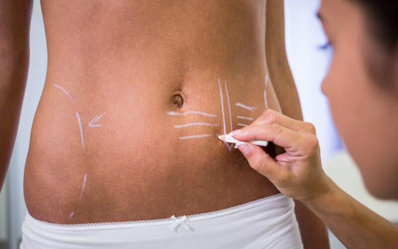 Lipoliza laserowa Warszawa: nowoczesne podejście do modelowania sylwetki