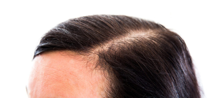 Wypadanie włosów u kobiet – przyczyny i skuteczne rozwiązania