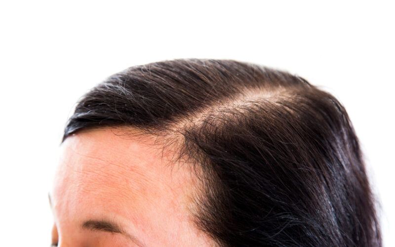 Wypadanie włosów u kobiet – przyczyny i skuteczne rozwiązania