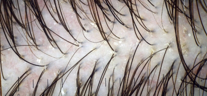 Trichoskopia – co to za badanie i komu jest dedykowane?