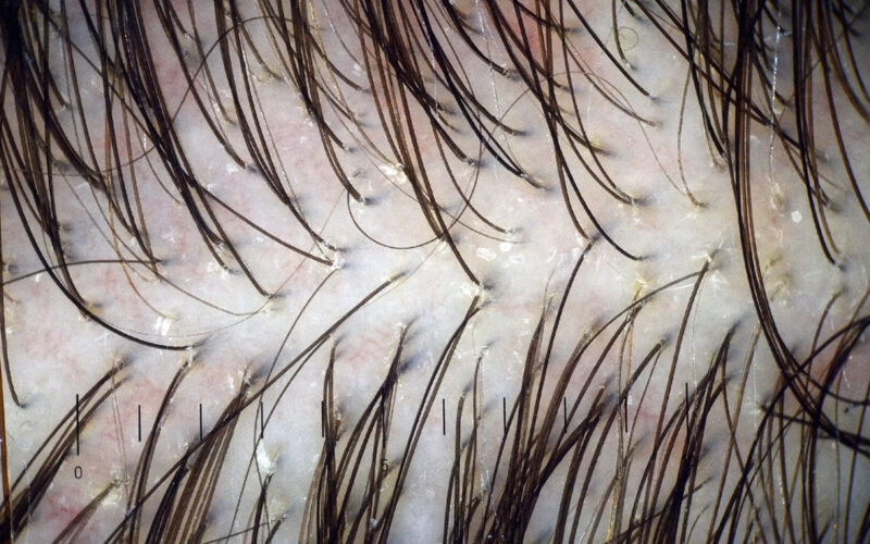 Trichoskopia – co&nbsp;to&nbsp;za&nbsp;badanie i&nbsp;komu&nbsp;jest dedykowane?